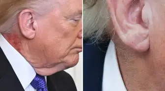 ABD Başkanı Donald Trump'ın boynundaki kızarıklık, Almanya Şansölyesi Friedrich Merz